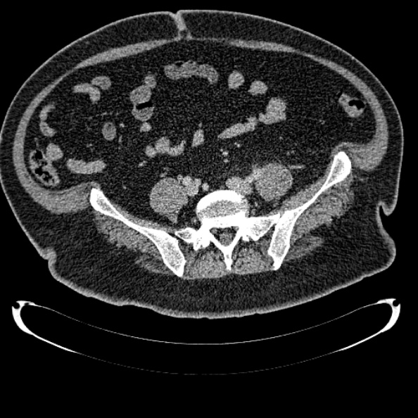 Bosniak renal cyst - type IV (Radiopaedia 24244-24518 C 280).jpg