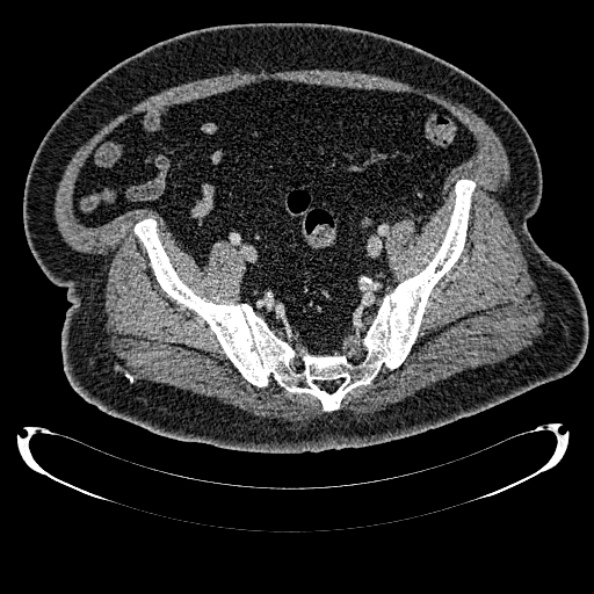 Bosniak renal cyst - type IV (Radiopaedia 24244-24518 C 322).jpg
