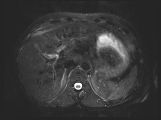 File:Bouveret syndrome (Radiopaedia 61017-68856 Axial MRCP 14).jpg