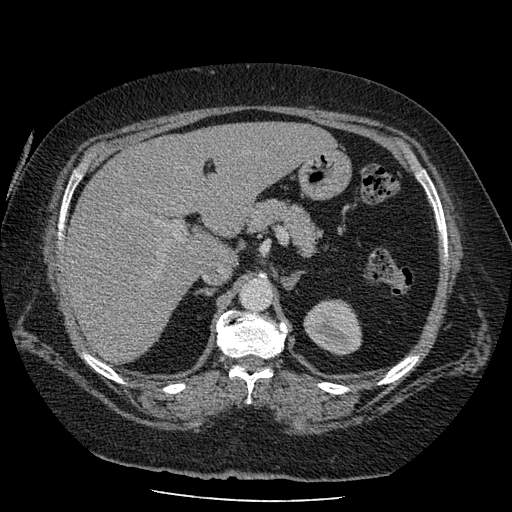 Bovine aortic arch - right internal mammary vein drains into the superior vena cava (Radiopaedia 63296-71875 A 182).jpg