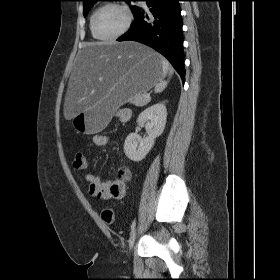 Bowel and splenic infarcts in acute lymphocytic leukemia (Radiopaedia 61055-68913 C 32).jpg
