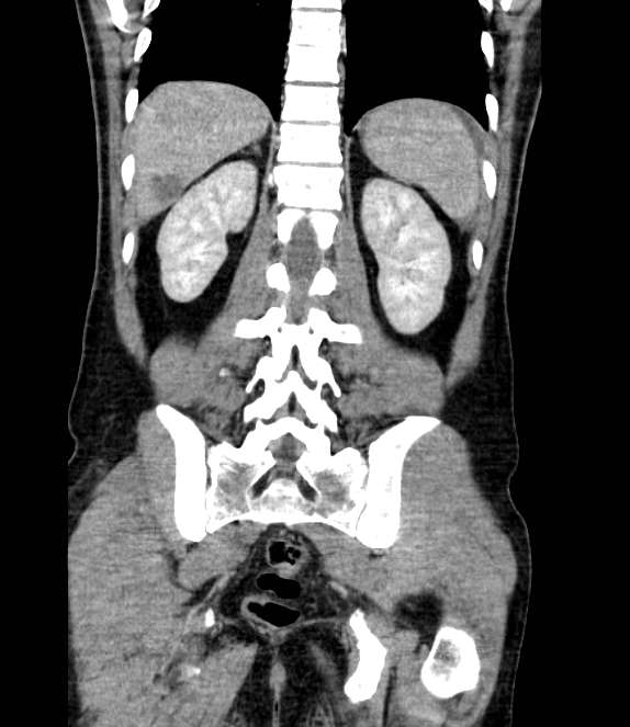 Bowel obstruction from colon carcinoma (Radiopaedia 22995-23028 C 57).jpg