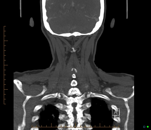 Brachiocephalic trunk stenosis (Radiopaedia 87242-103519 B 60).jpg