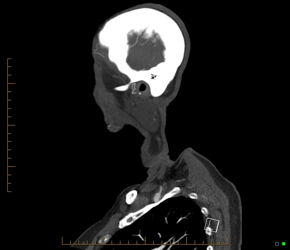 Brachiocephalic trunk stenosis (Radiopaedia 87242-103519 C 5).jpg