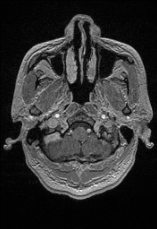 Brain abscess with ventriculitis (Radiopaedia 85703-101495 Axial T1 C+ 27).jpg