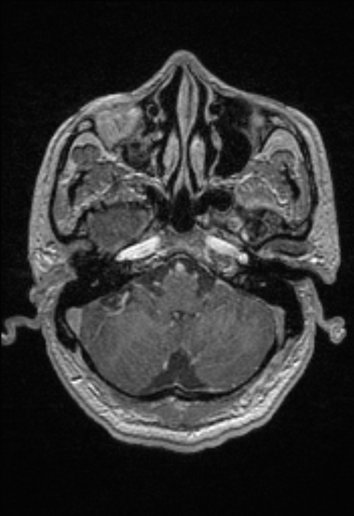 Brain abscess with ventriculitis (Radiopaedia 85703-101495 Axial T1 C+ 42).jpg