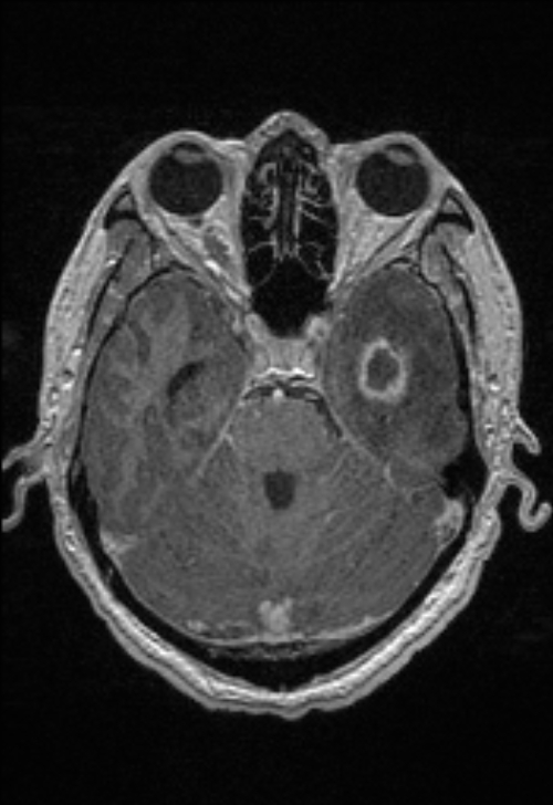 Brain abscess with ventriculitis (Radiopaedia 85703-101495 Axial T1 C+ 61).jpg