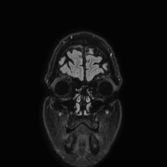 Brain metastases from lung cancer (Radiopaedia 83839-99028 Coronal FLAIR 3).jpg