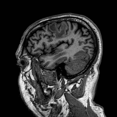 Brain metastases from lung cancer (Radiopaedia 83839-99028 Sagittal T1 103).jpg