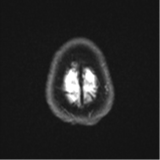 File:Brain metastasis (large cystic mass) (Radiopaedia 47497-52107 Axial DWI 26).png