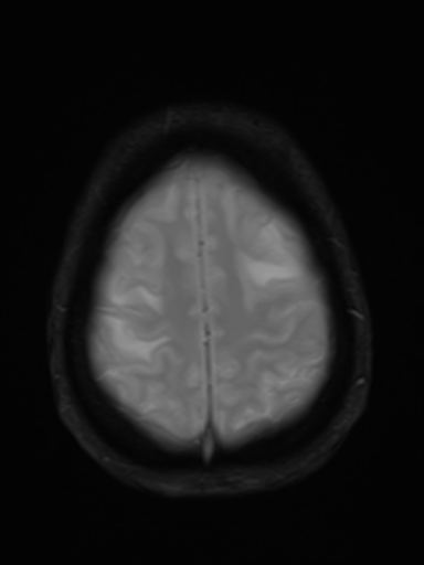File:Brain metastasis as initial presentation of non-small cell lung cancer (Radiopaedia 65122-74126 Axial T2* 16).jpg