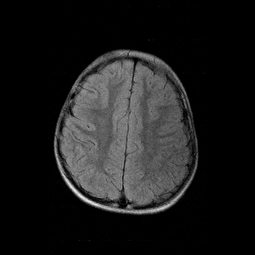 File:Brainstem ganglioglioma (Radiopaedia 10763-11224 Axial FLAIR 5).jpg