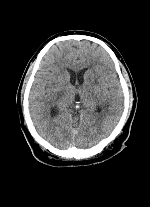 Brainstem hemorrhage (Radiopaedia 81294-94976 Axial non-contrast 33).jpg
