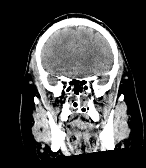 Brainstem hemorrhage (Radiopaedia 81294-94976 Coronal non-contrast 21).jpg