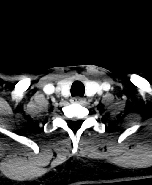 Branchial cleft cyst (Radiopaedia 31167-31875 Axial C+ delayed 56).jpg