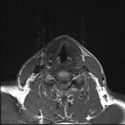 File:Branchial cleft cyst (Radiopaedia 31167-31876 Axial T1 1).jpg