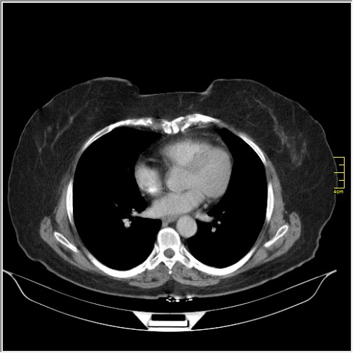 File:Breast cancer on thorax CT (Radiopaedia 60571-68275 A 61).JPG