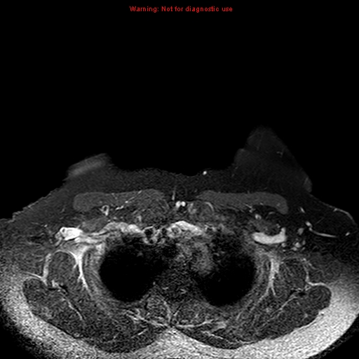 File:Breast carcinoma (multicentric multifocal in mammary Paget disease) (Radiopaedia 50966-56512 Axial T1 C+ fat sat 16).jpg