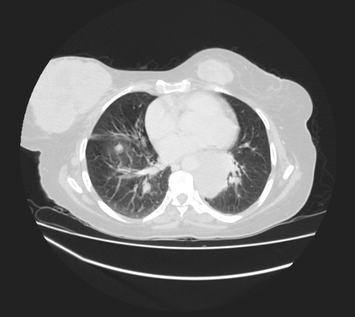 Breast metastases from facial malignant melanoma (Radiopaedia 60316-67975 Axial lung window 66).jpg