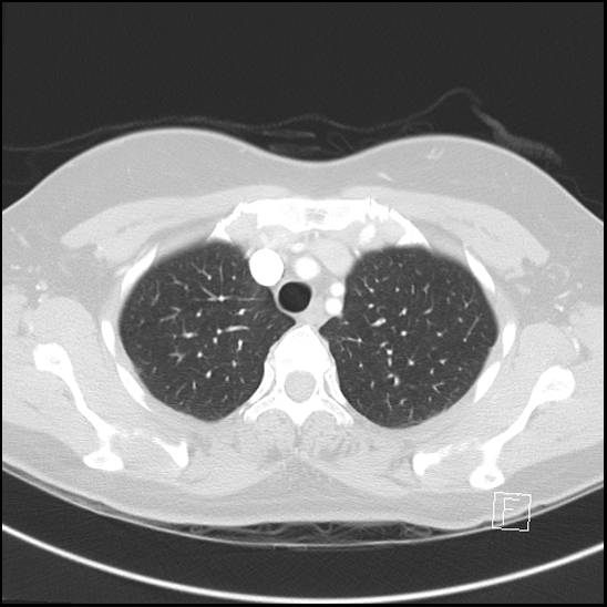 Breast metastases from renal cell cancer (Radiopaedia 79220-92225 Axial lung window 16).jpg