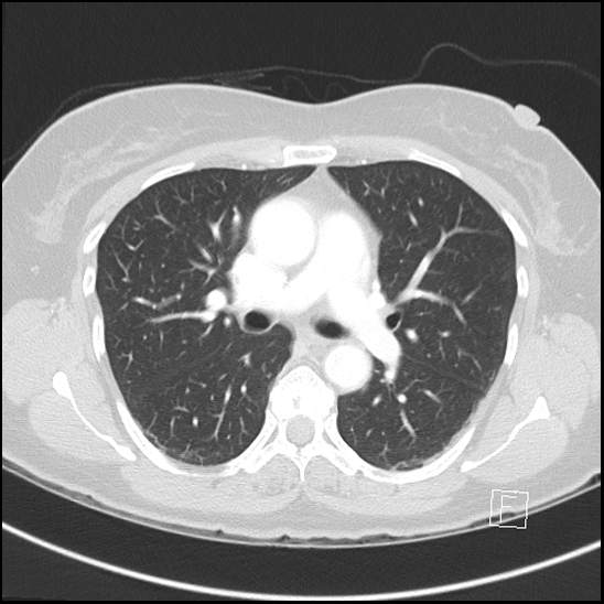 Breast metastases from renal cell cancer (Radiopaedia 79220-92225 Axial lung window 36).jpg