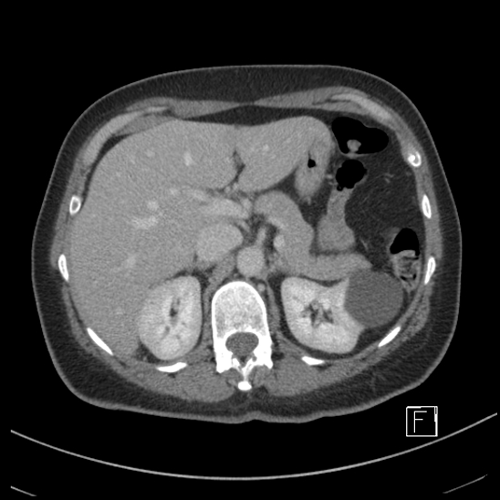 Breast metastases from renal cell cancer (Radiopaedia 79220-92225 C 26).jpg
