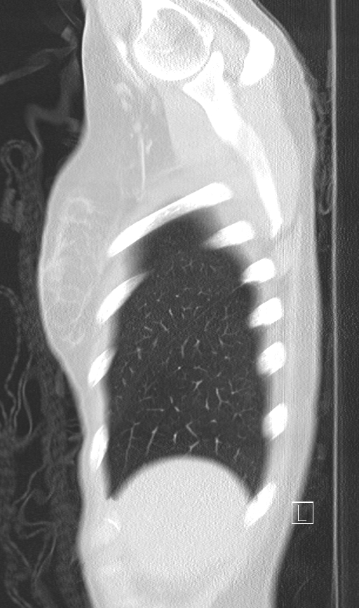 Bronchial atresia (Radiopaedia 73677-84470 Sagittal lung window 5).jpg