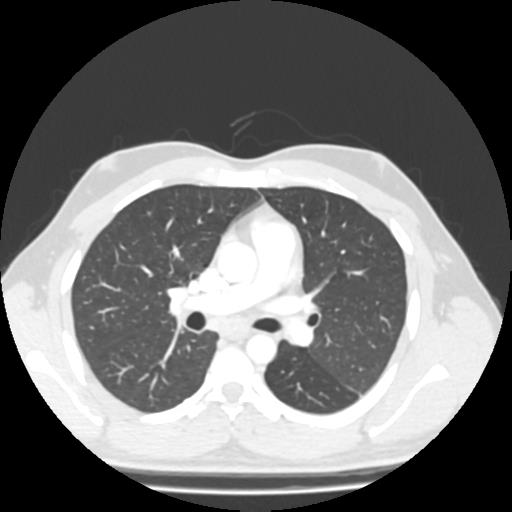 File:Bronchial carcinoid (Radiopaedia 80013-93291 Axial lung window 49).jpg