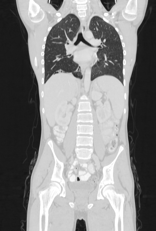 Bronchial carcinoid tumor (Radiopaedia 57187-64090 Coronal lung window 55).jpg