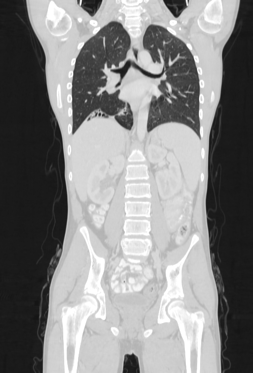 Bronchial carcinoid tumor (Radiopaedia 57187-64090 Coronal lung window 59).jpg