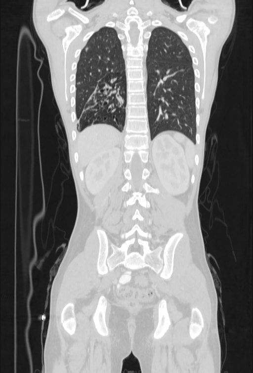 Bronchial carcinoid tumor (Radiopaedia 57187-64090 Coronal lung window 85).jpg