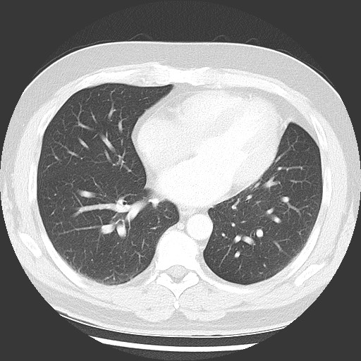 Bronchial carcinoid tumor (Radiopaedia 67377-76764 Axial lung window 40).jpg