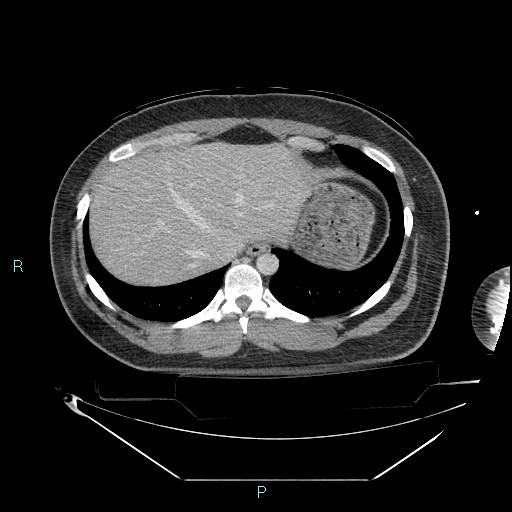 Bronchial carcinoid tumor (Radiopaedia 78272-90870 C 102).jpg