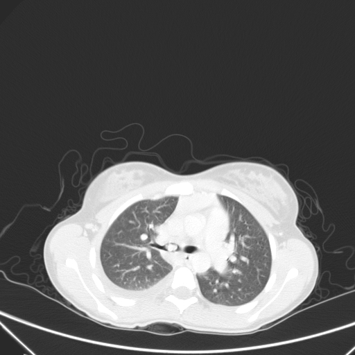 Bronchial mucoepidermoid carcinoma (Radiopaedia 57023-63895 Axial lung window 39).jpg
