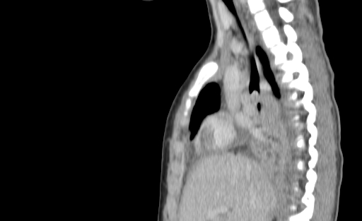 Bronchial mucoepidermoid carcinoma (Radiopaedia 57023-63895 Sagittal 94).jpg