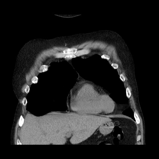 Bronchial stenosis - lung transplant (Radiopaedia 73133-83848 Coronal non-contrast 20).jpg