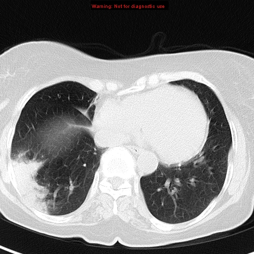 File:Bronchoalveolar carcinoma (BAC) (Radiopaedia 13436-13392 Axial lung window 36).jpg