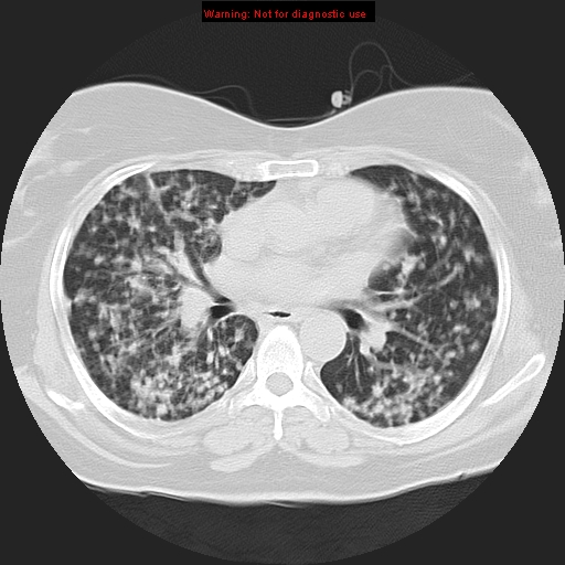 Bronchoalveolar carcinoma (Radiopaedia 13224-13233 Axial lung window 24).jpg