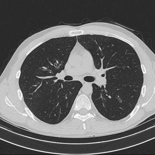 File:Bronchocele (Radiopaedia 60676-68429 Axial lung window 31).jpg