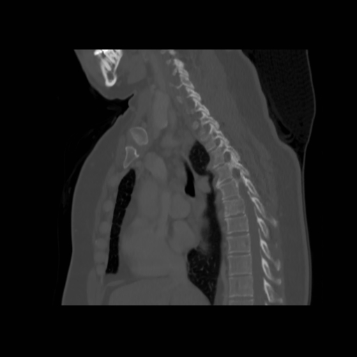 Bronchogenic carcinoma (Radiopaedia 73497-84262 Sagittal bone window 76).jpg
