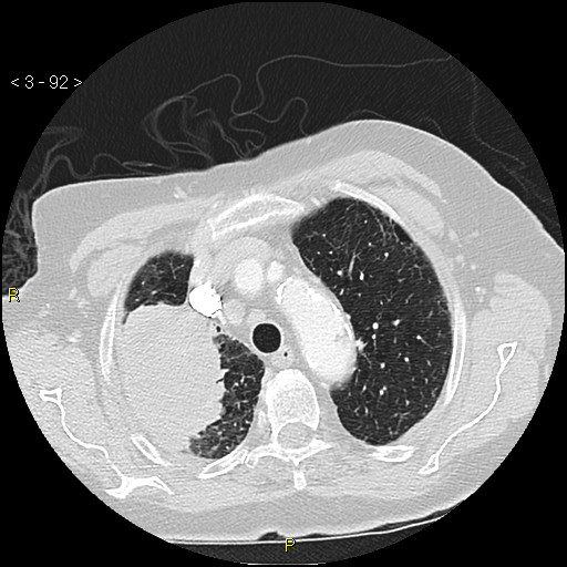 Bronchogenic carcinoma as an incidental finding (Radiopaedia 16453-16130 Axial lung window 92).jpg
