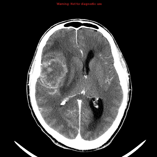 File:Bronchogenic carcinoma brain metastasis (Radiopaedia 9286-9970 B 15).jpg