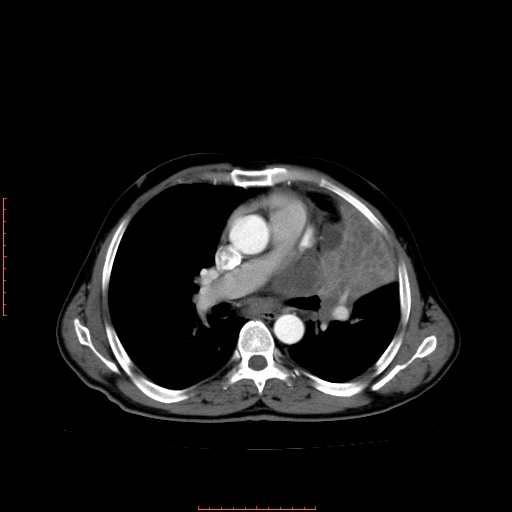 File:Bronchogenic carcinoma with left atrial large deposit - T4N3M1a (Radiopaedia 42316-45428 A 15).jpg