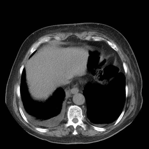 Bronchogenic carcinoma with metastatic lymphadenopathy (Radiopaedia 37671-39569 Axial non-contrast 45).jpg