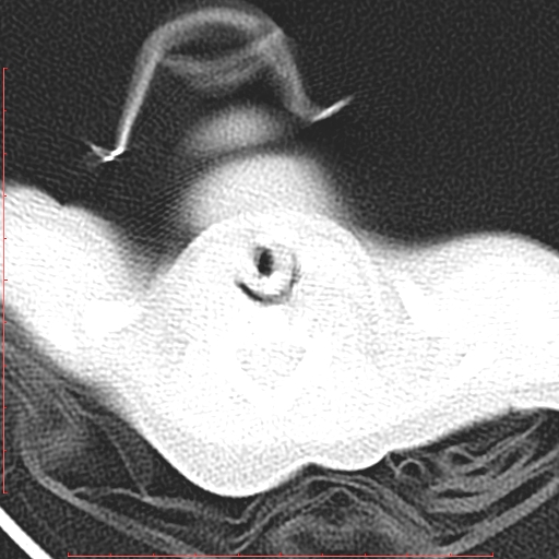 Bronchogenic cyst (Radiopaedia 78599-91409 Axial lung window 5).jpg