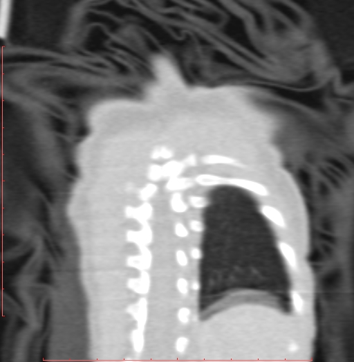 Bronchogenic cyst (Radiopaedia 78599-91409 Coronal lung window 203).jpg