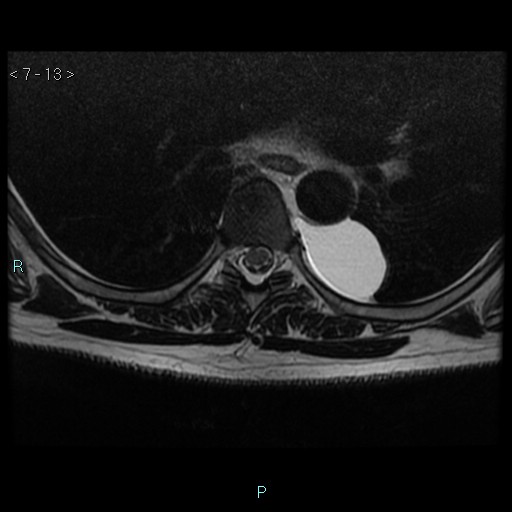 File:Bronchogenic cyst - posterior mediastinal (Radiopaedia 43885-47365 Axial T2 13).jpg