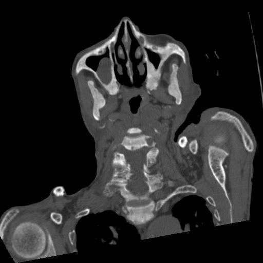File:Brown tumor with secondary hyperparathyroidism (Radiopaedia 23591-23705 C 31).jpg