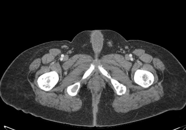 File:Brown tumors compressing the spinal cord (Radiopaedia 68442-77988 E 135).jpg