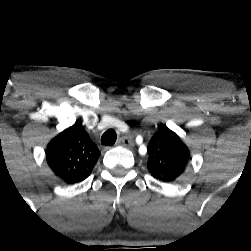Buccal fat pad arteriovenous malformation (Radiopaedia 70936-81144 D 23).jpg